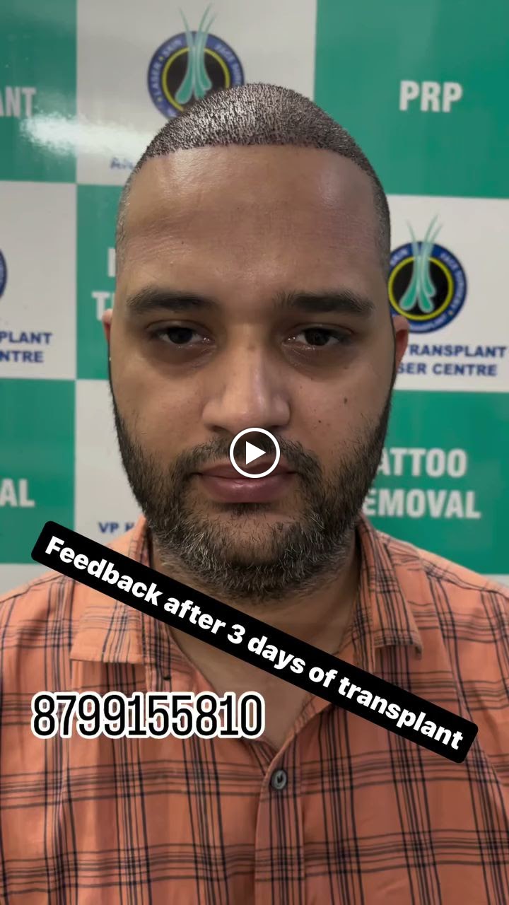 FUE Hair Transplant Procedure